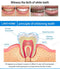 Teeth Whitening Essence - WELLQHOME